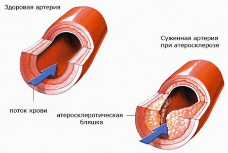 Холестерин. Kрупнейшая афера XX века